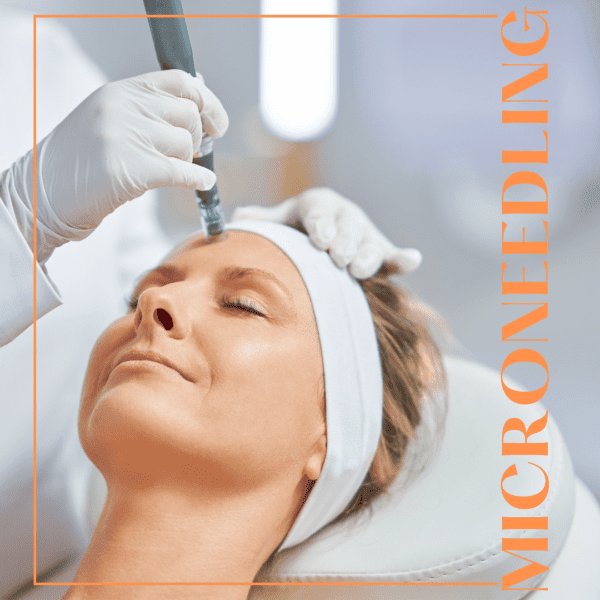 Microneedling at London Aesthetics showing the procedure on a female patient to improve her skin care