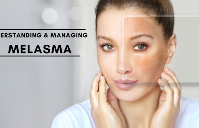 UNDERSTANDING & MANAGING MELASMA