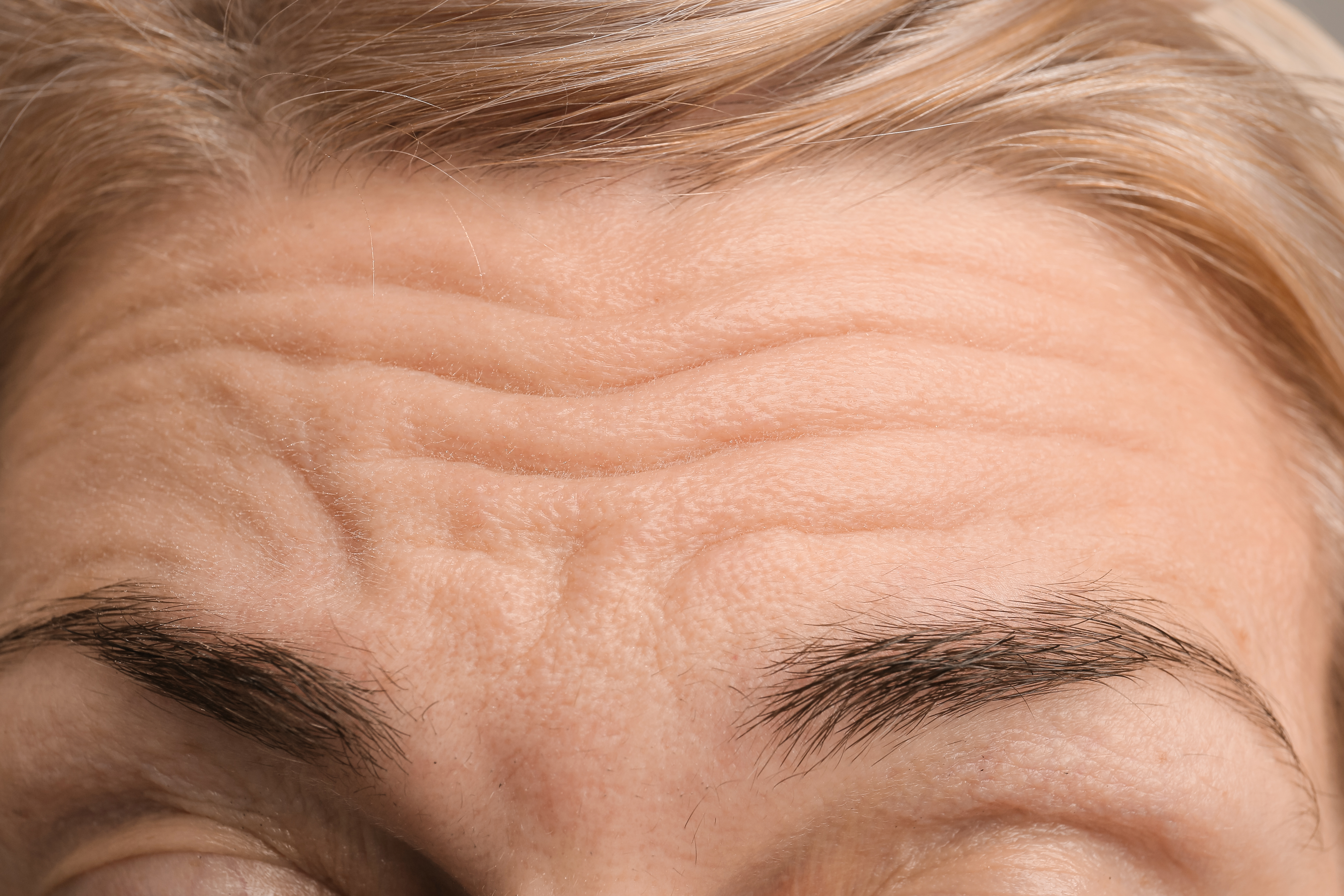Forehead lines