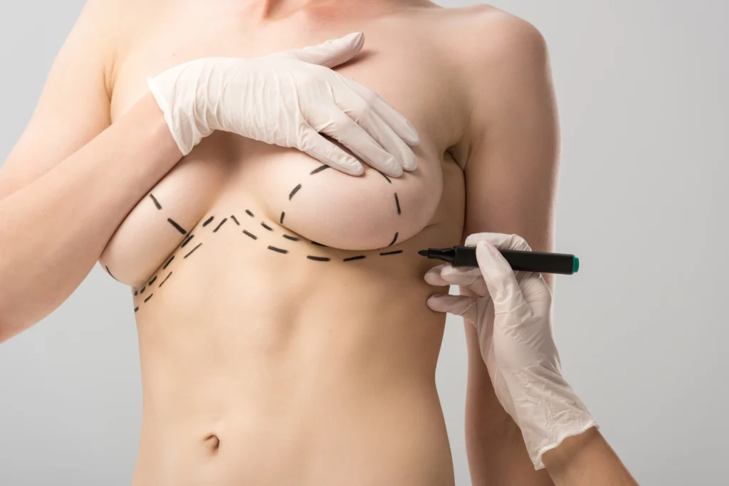 Breast Lift