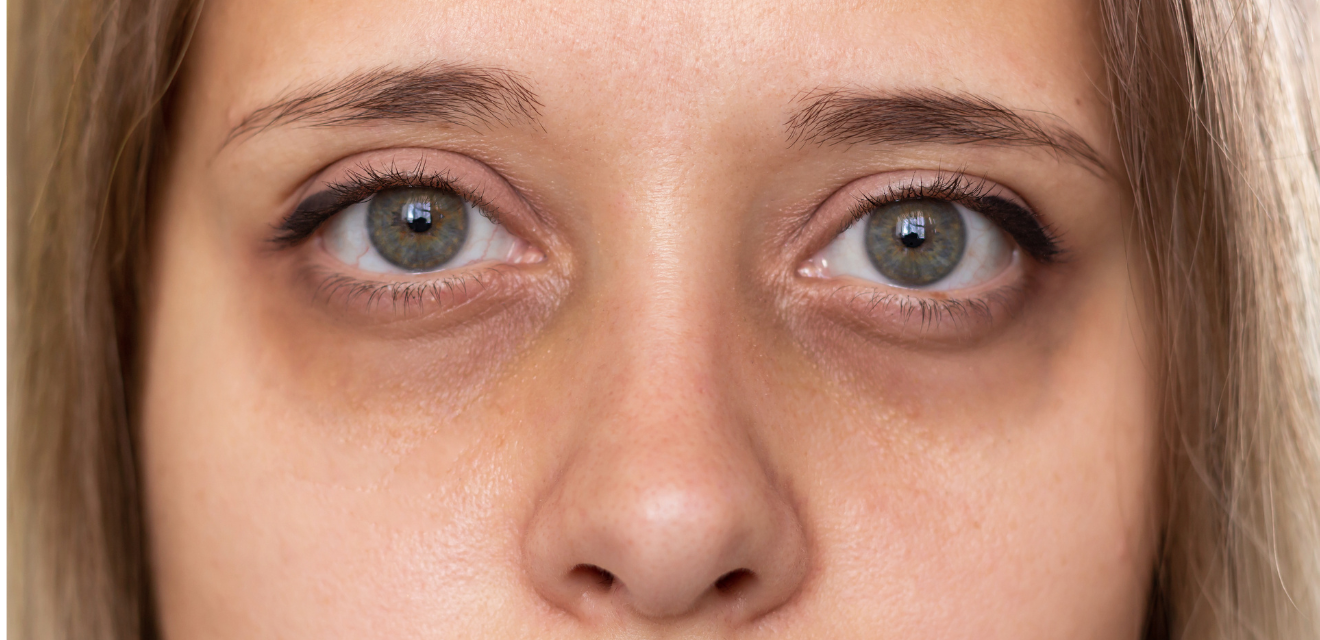 Before and after results of dark circle treatment at London Aesthetics in Pakistan