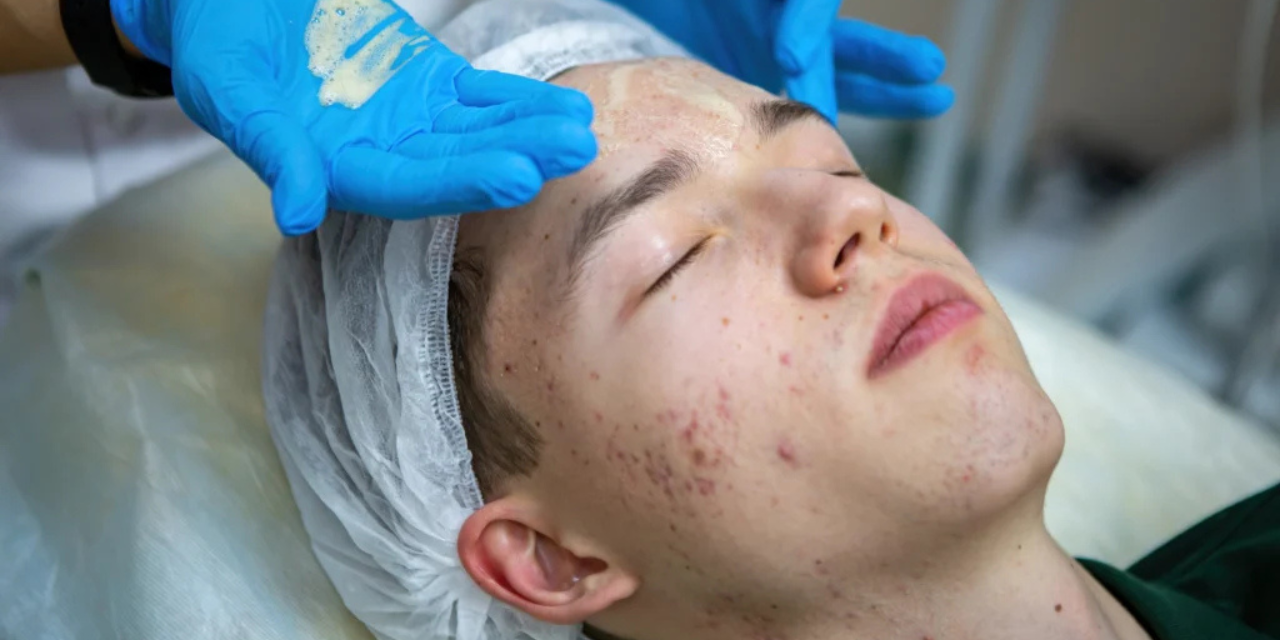 Advanced Acne Treatment session at London Aesthetics U.K
